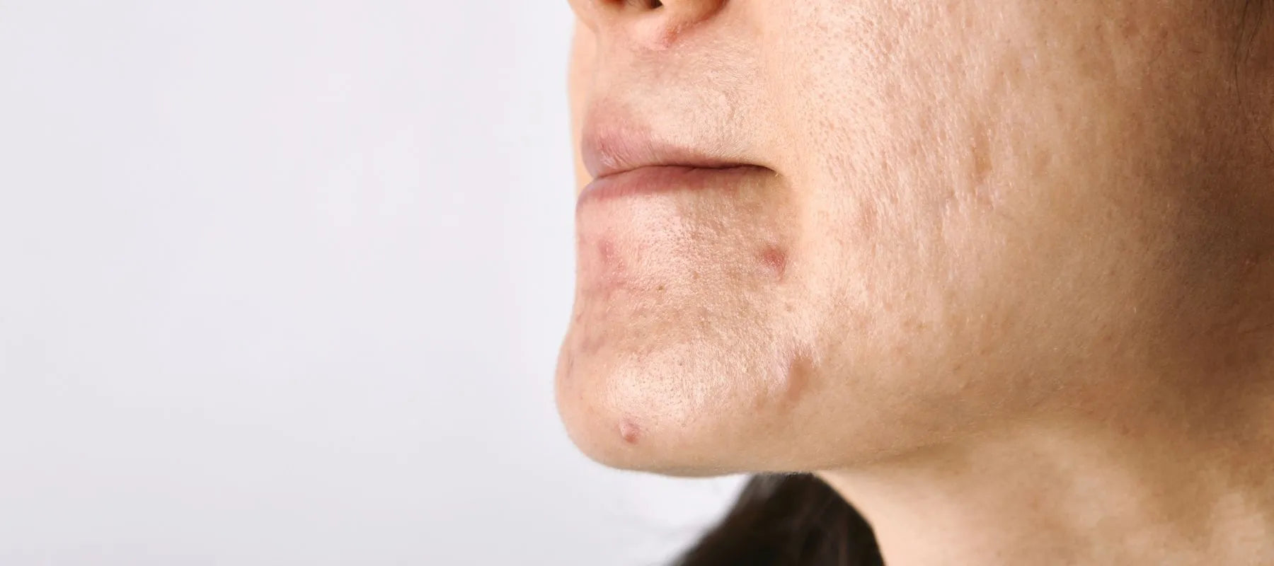Acne Around Mouth