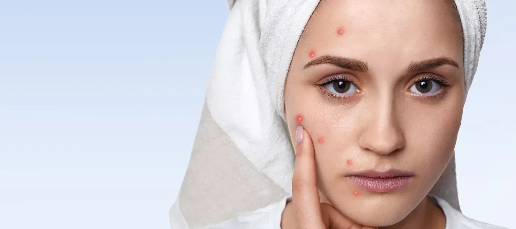 Does Paneer Cause Acne