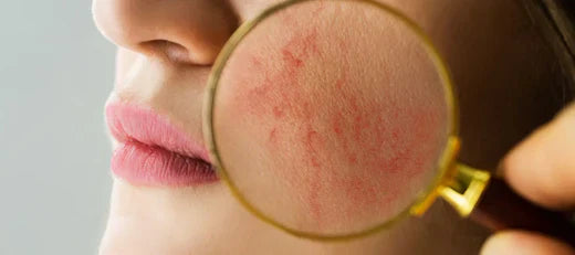Signs of an allergic reaction on the face