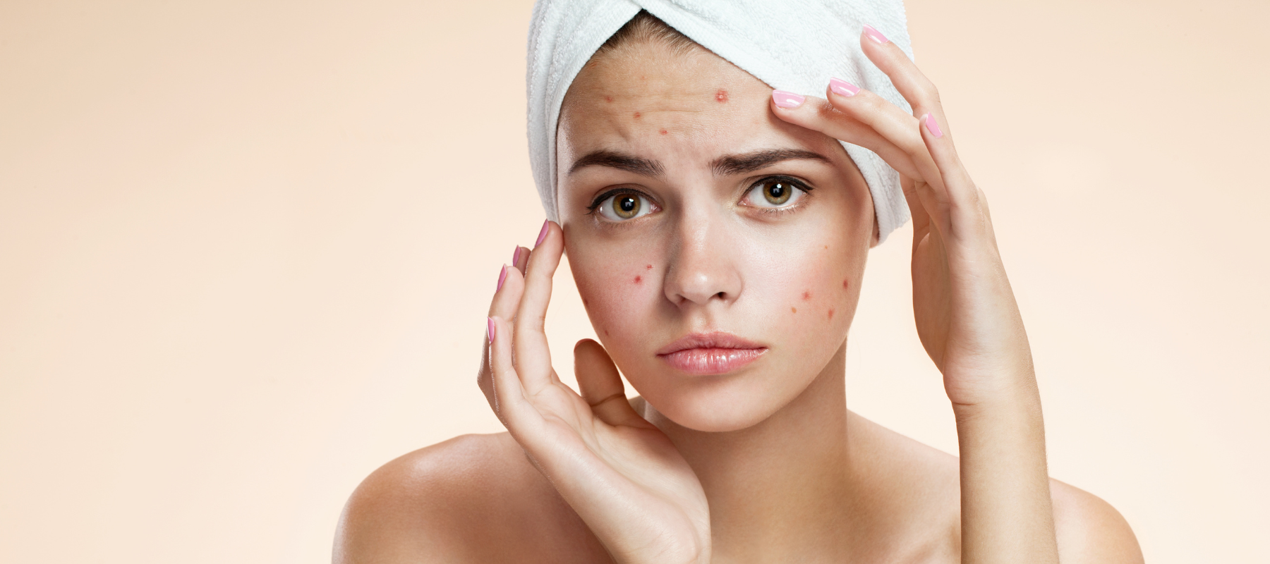 Applying ice on pimples