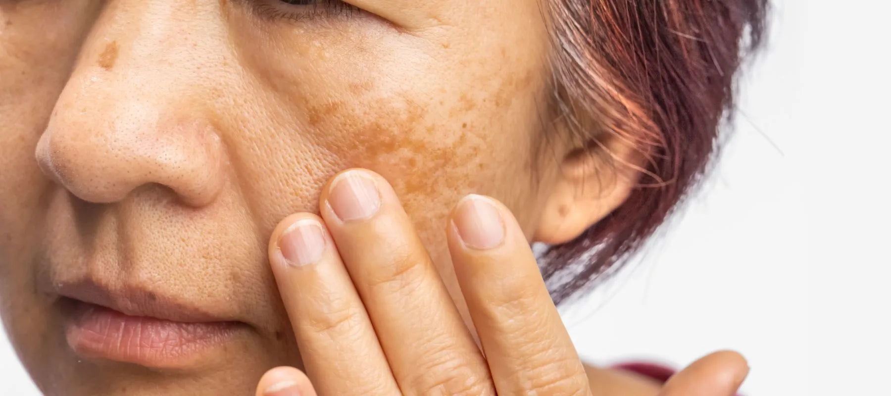 Broken skin on face