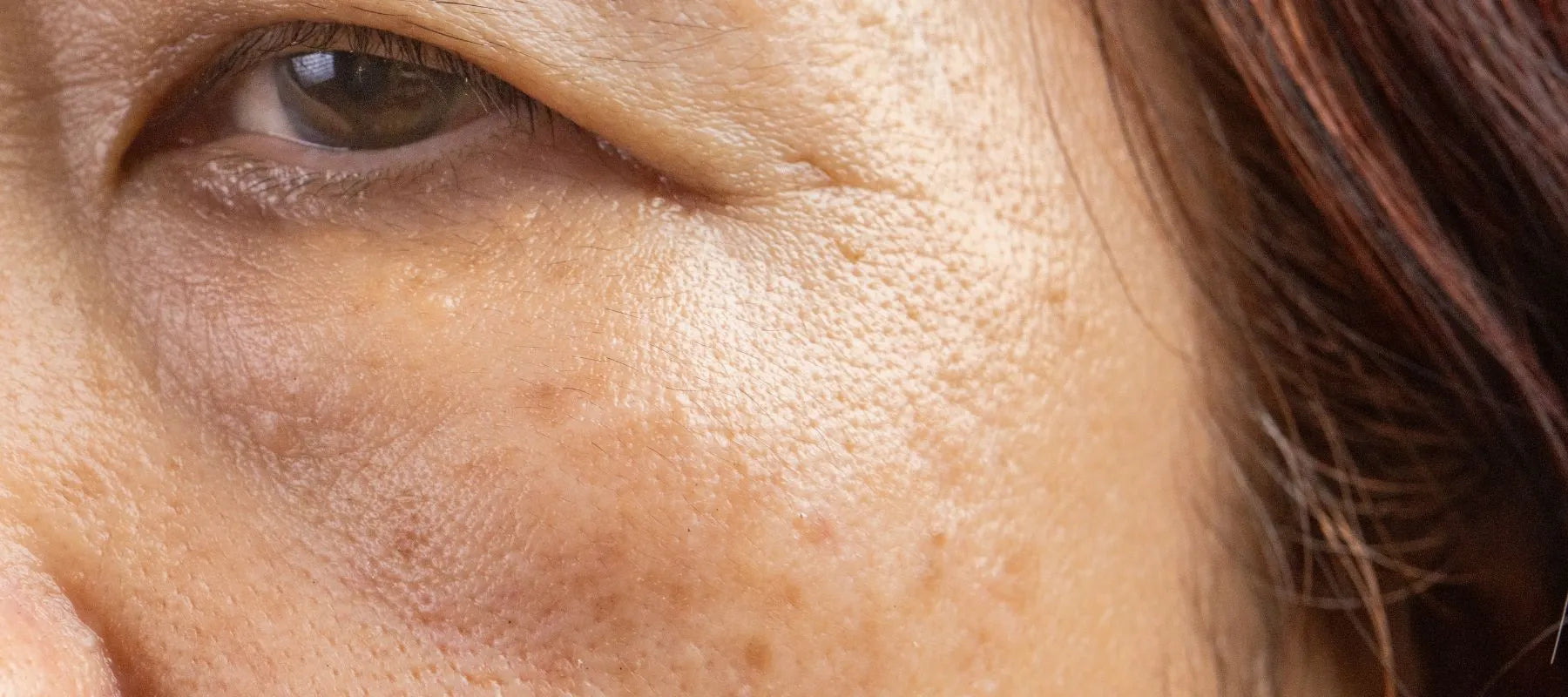 Brown spots on face