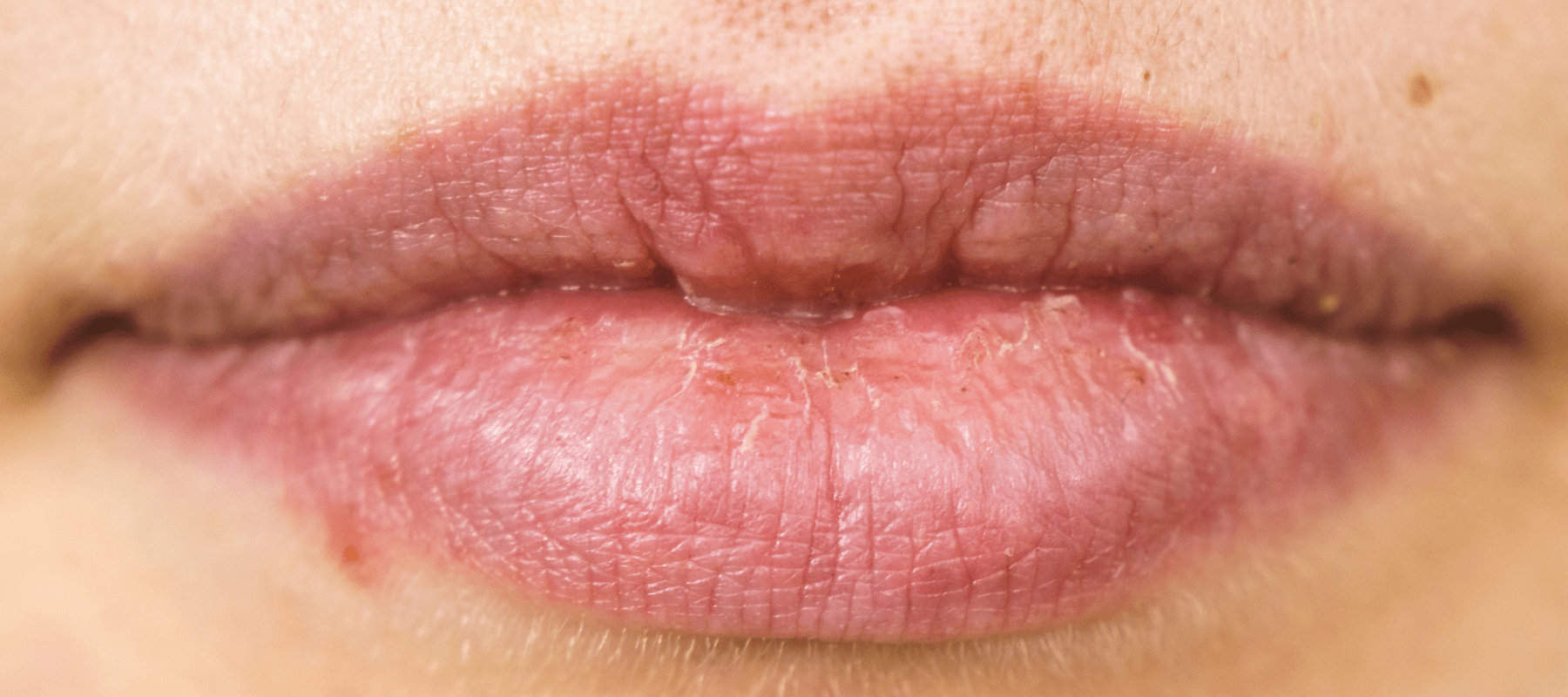 Causes and effective ways to get rid of lip pimples
