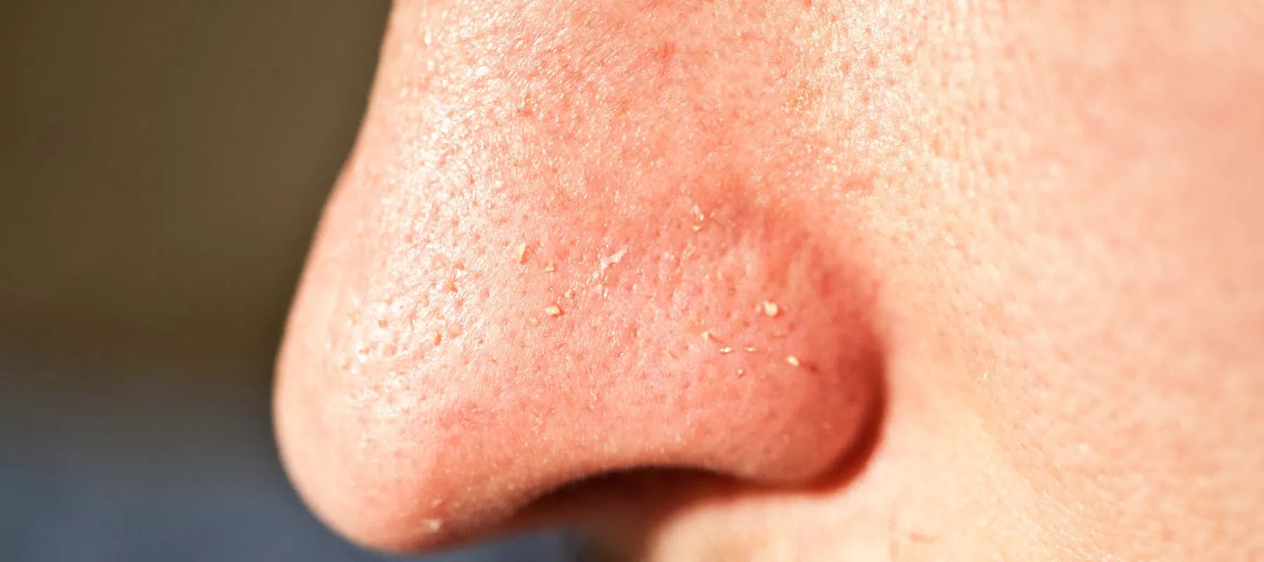 Clogged pores on nose