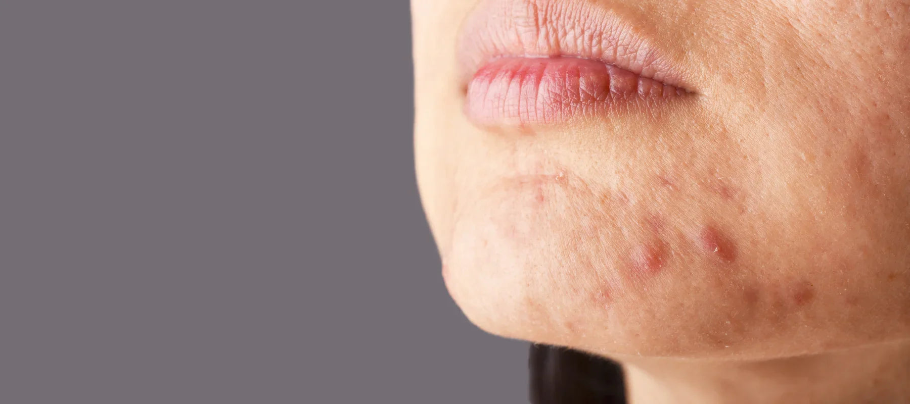 What is acne on face