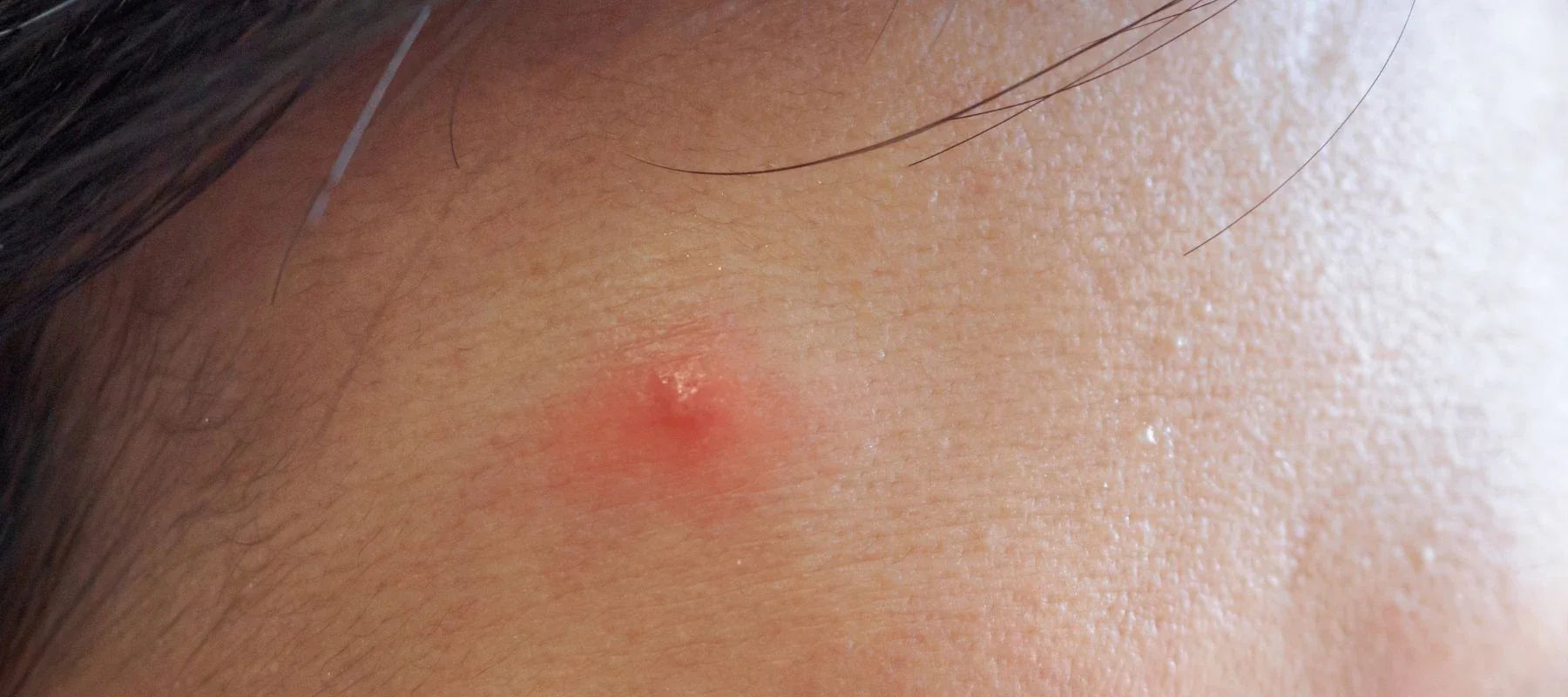 Inflammatory acne