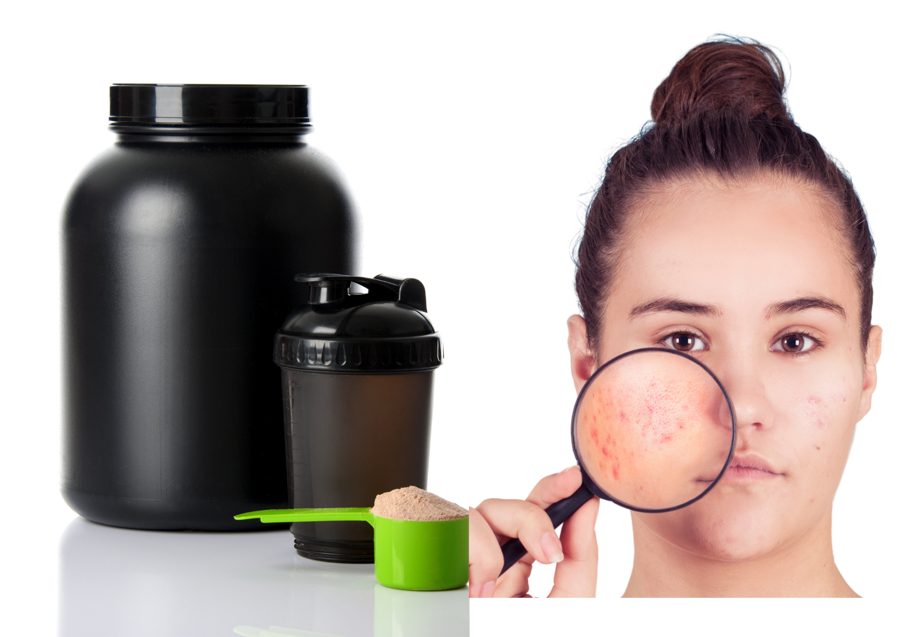 Does Whey Protein Cause Acne?