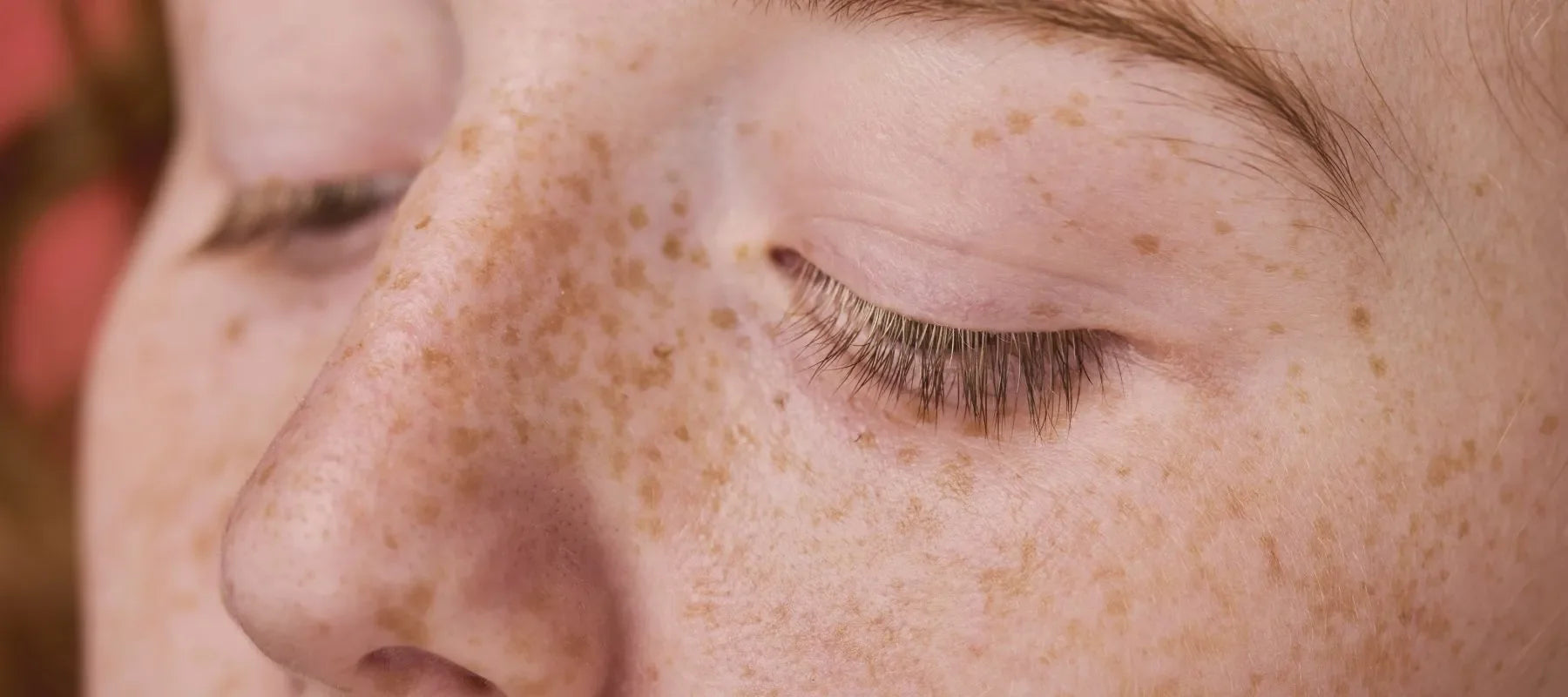 do freckles fade after using melanotan I accidentally undid years of skin work and didnt realize it until it was too late., At the beginning of November, I started taking 2 and honestly?, I loved it., My tan deepened Ephelides - Cryopen