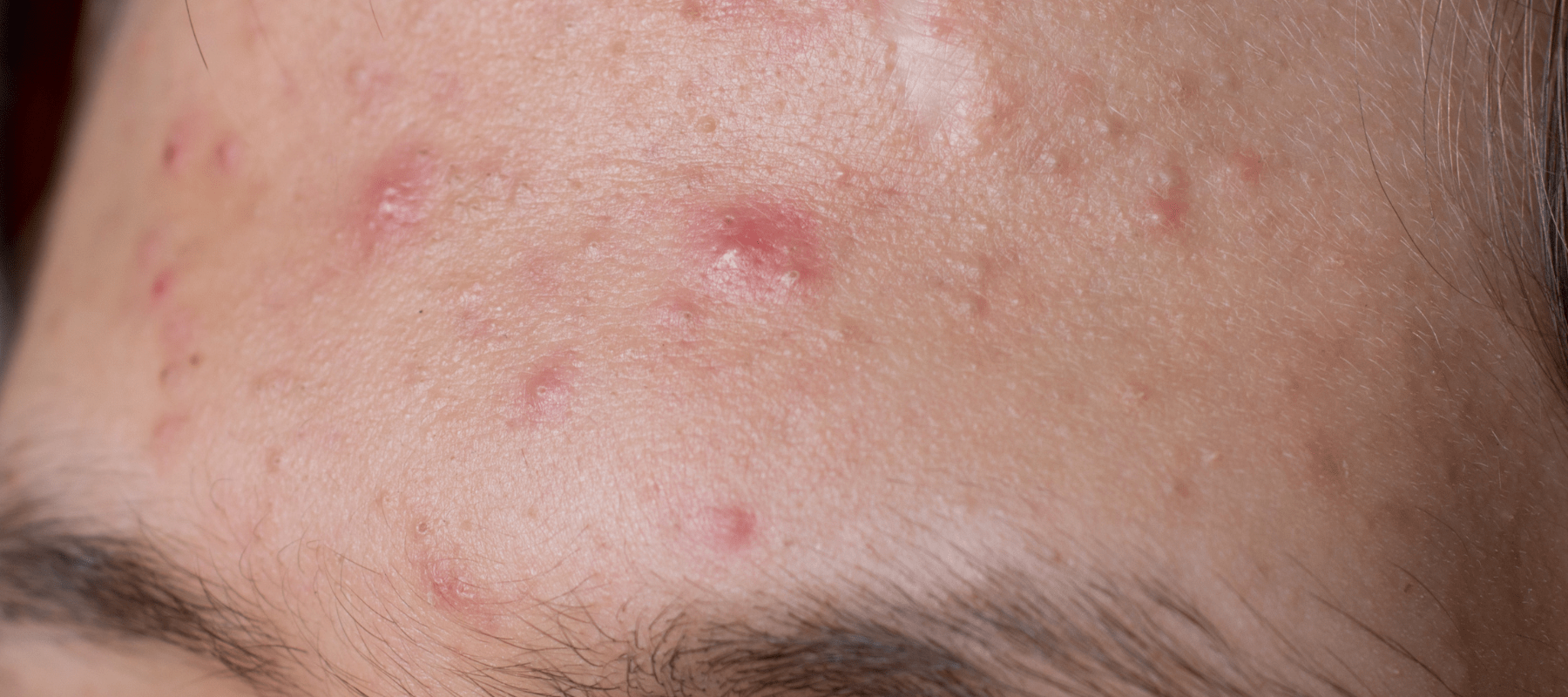 Guide on how to get rid of forehead acne