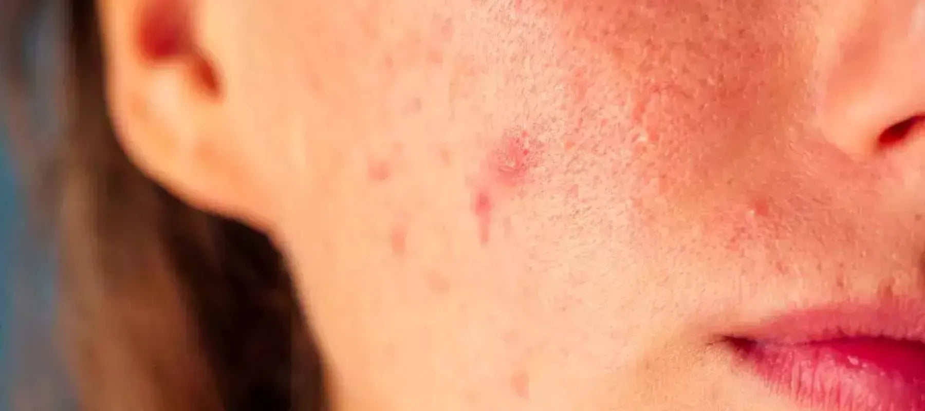 Heat boils on face
