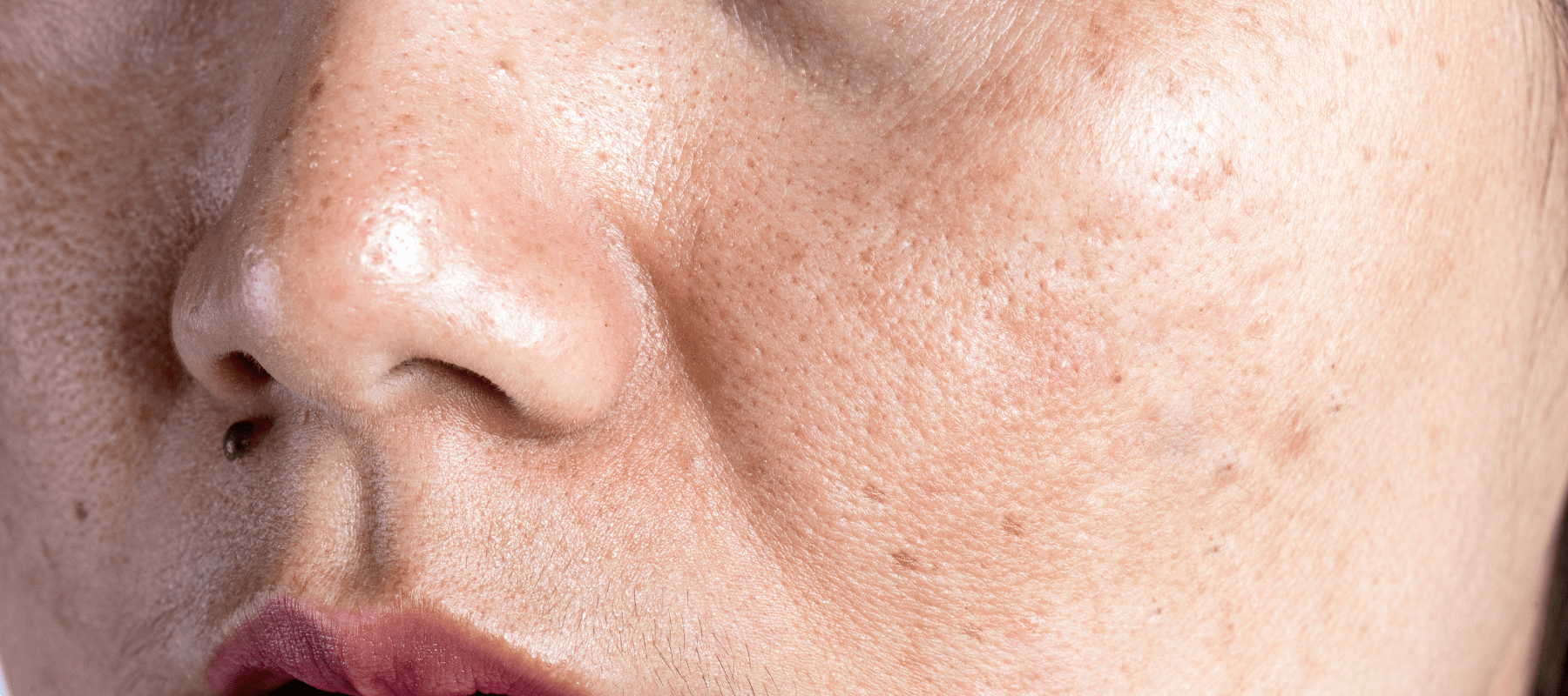 Facial Skin Discoloration: Causes, Treatment and Prevention | The Pink Foundry Facial Skin Discoloration: Causes, Treatment and Prevention | The Pink Foundry