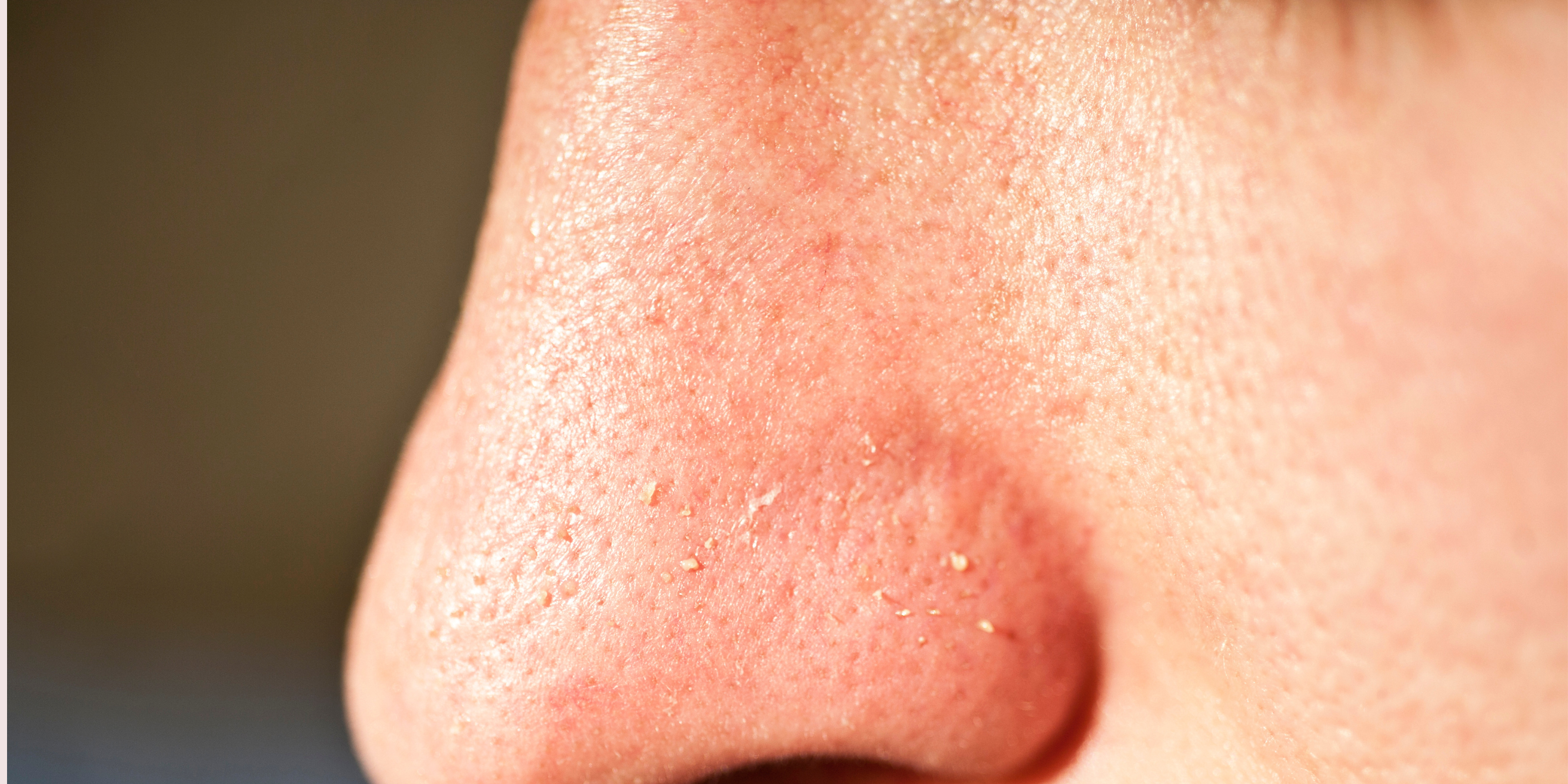 How are Whiteheads formed and How to prevent them