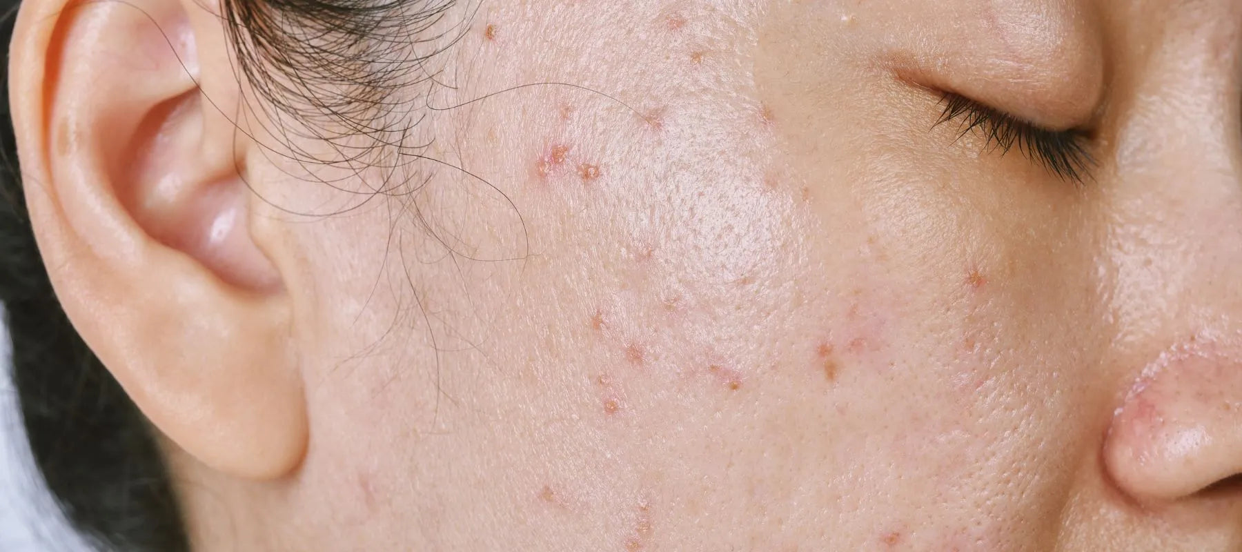 Pimple Marks Prevention