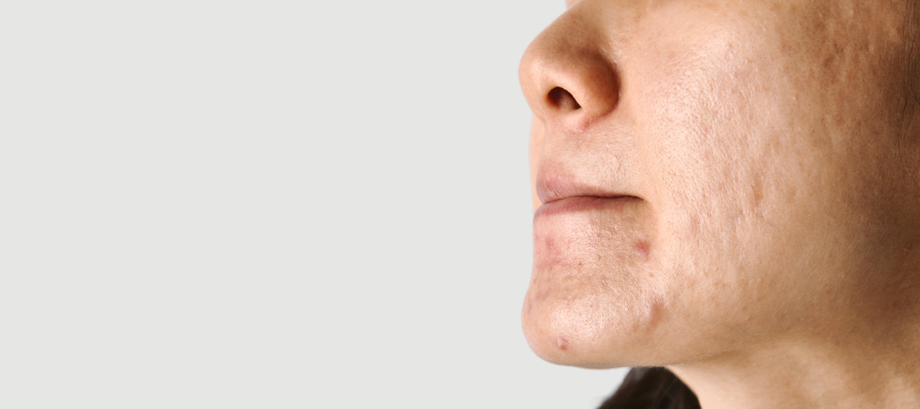 How to Remove Pigmentation Around Mouth