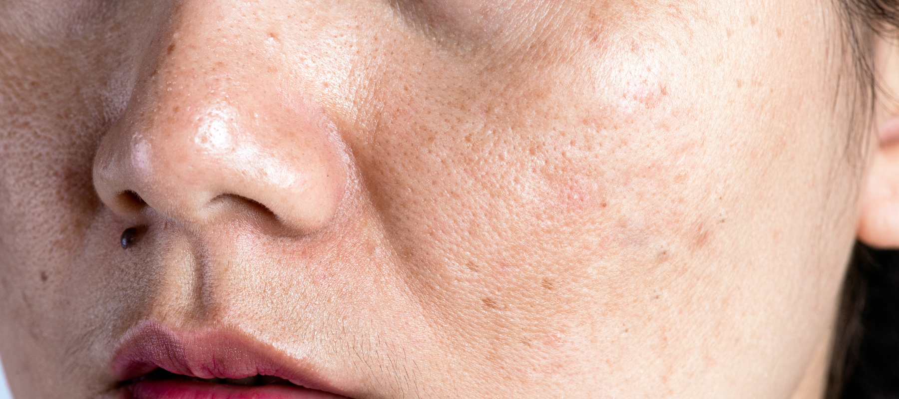 How to get rid of dark spots on face