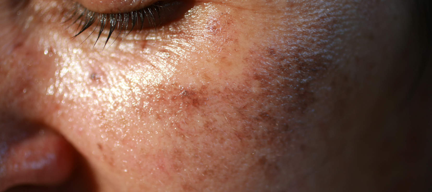 How to get rid of dark spots on your skin