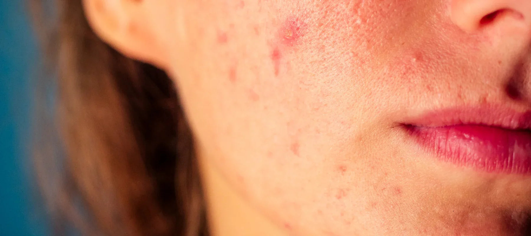 Jawline acne meaning and how to get rid of it