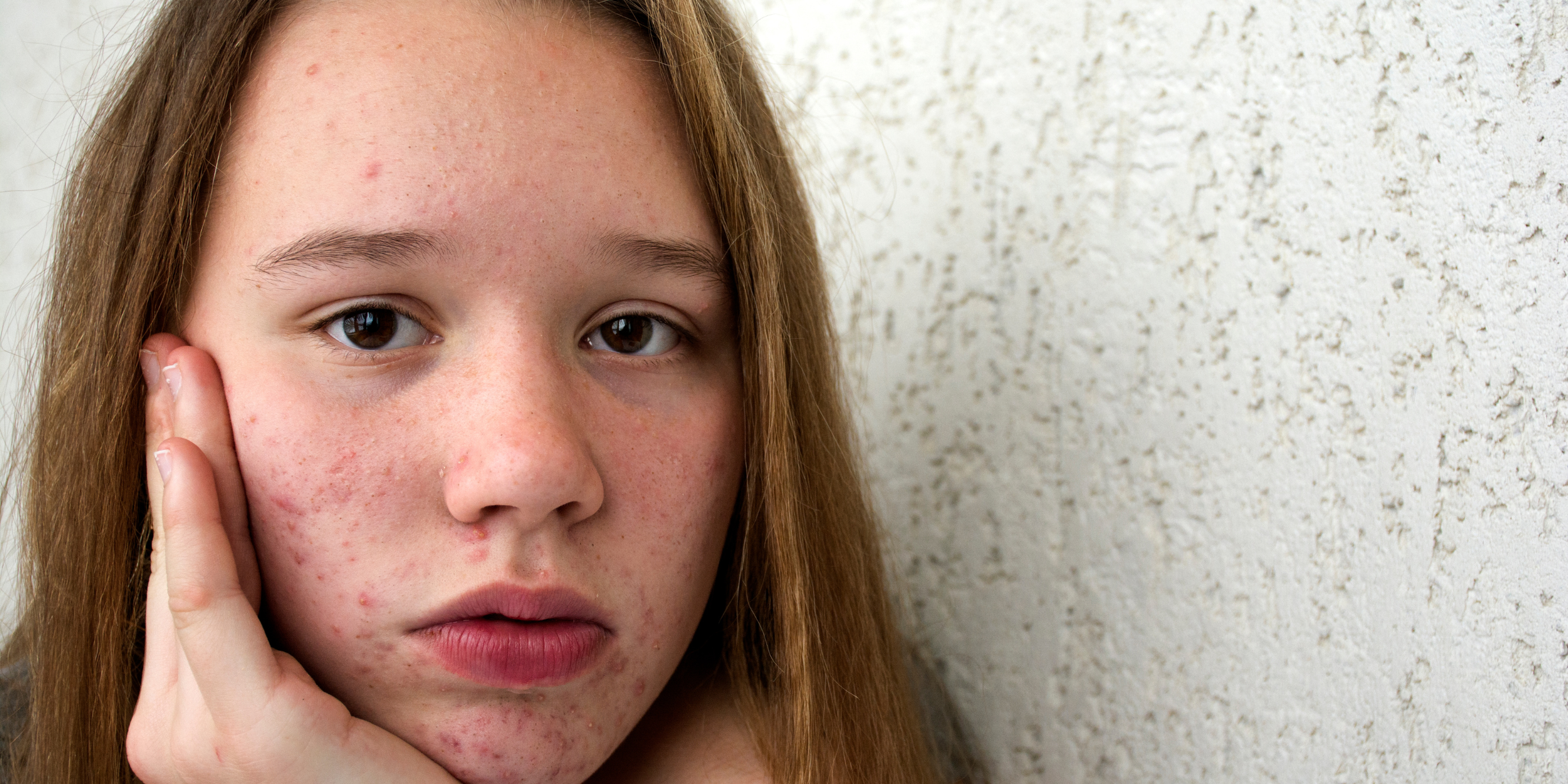 Know how to get rid of teenage pimples