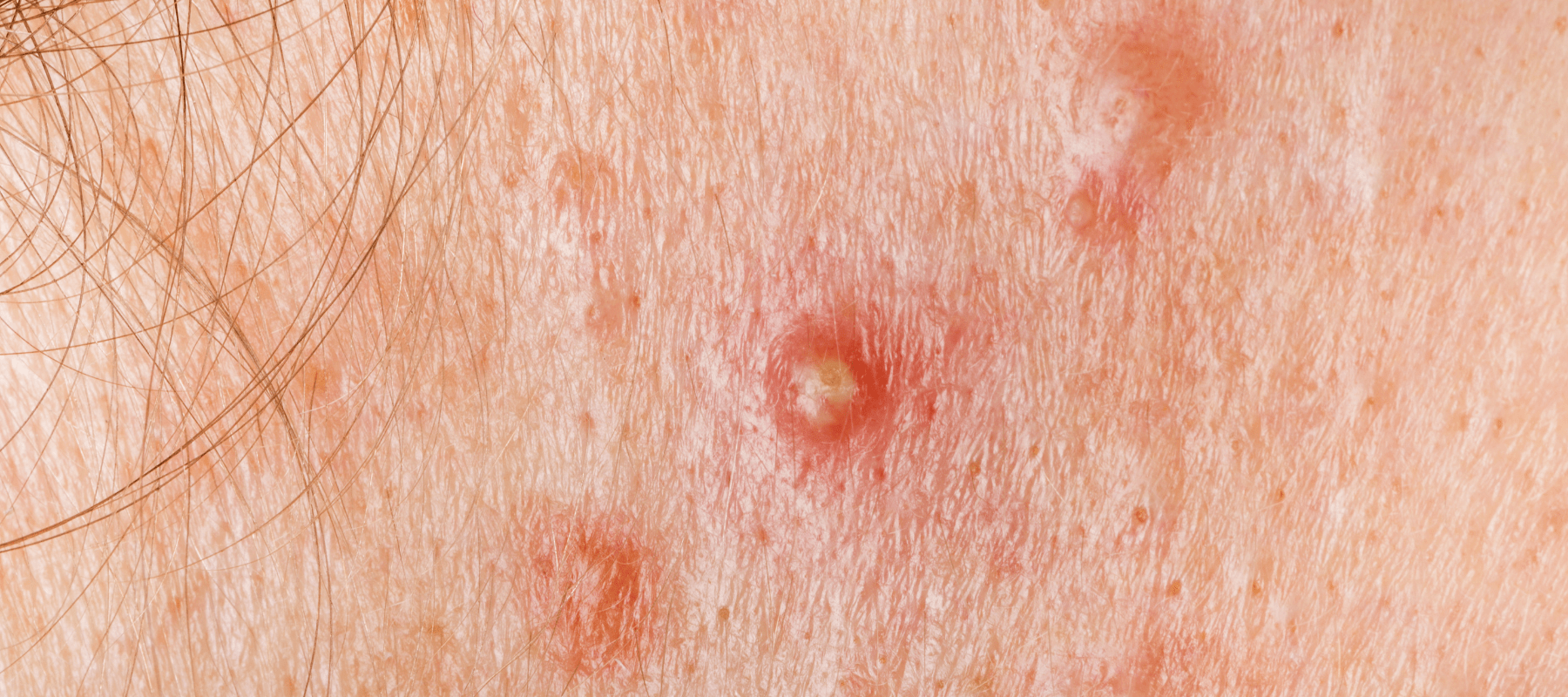 Know the causes and symptoms of nodular acne