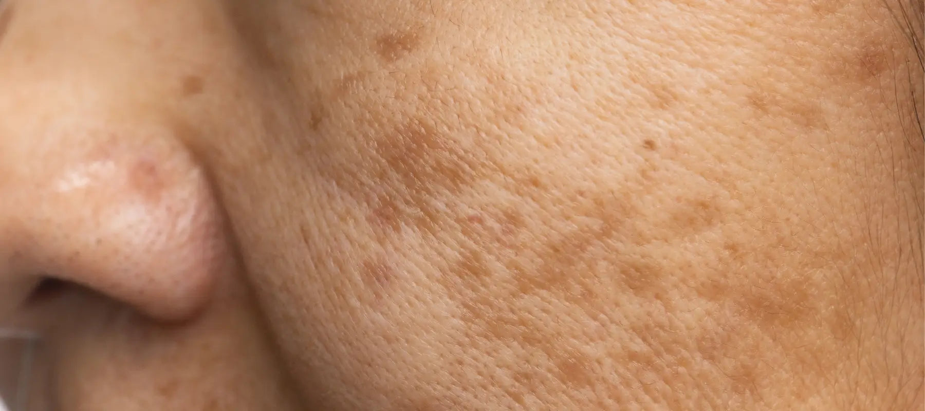 Symptoms of melasma on face