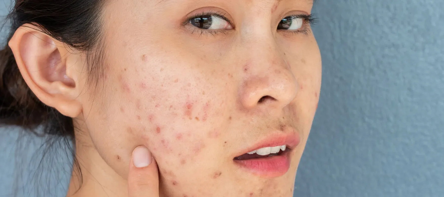 Do acne scars go away