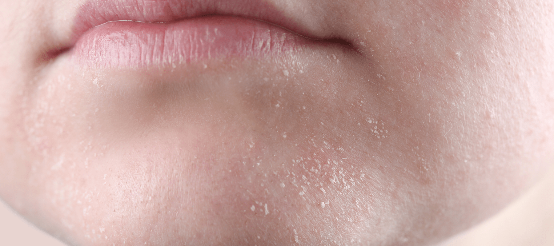 Niacinamide Benefits for Dry Skin: Hydration and More
