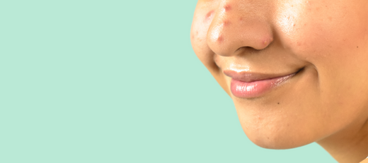Pimples on Nose