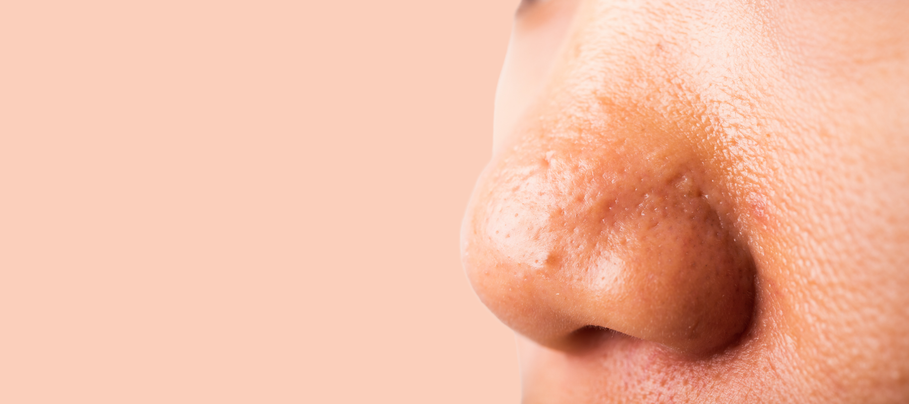Pimples on Nose