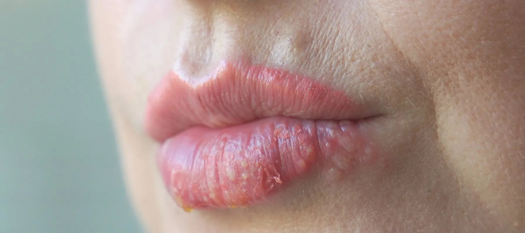 Prevention: Keep the Lip Area Clear