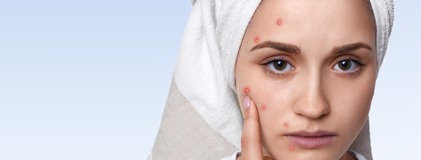 When does pregnancy acne start and how long it lasts