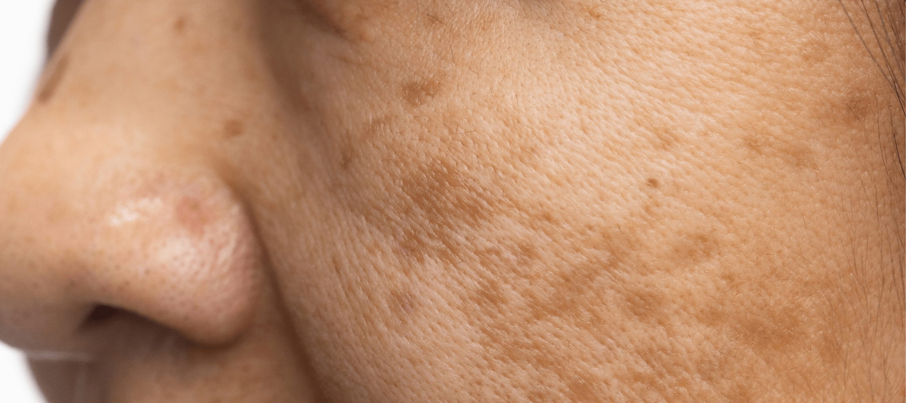 Process and results for removing dark sun spots on the face