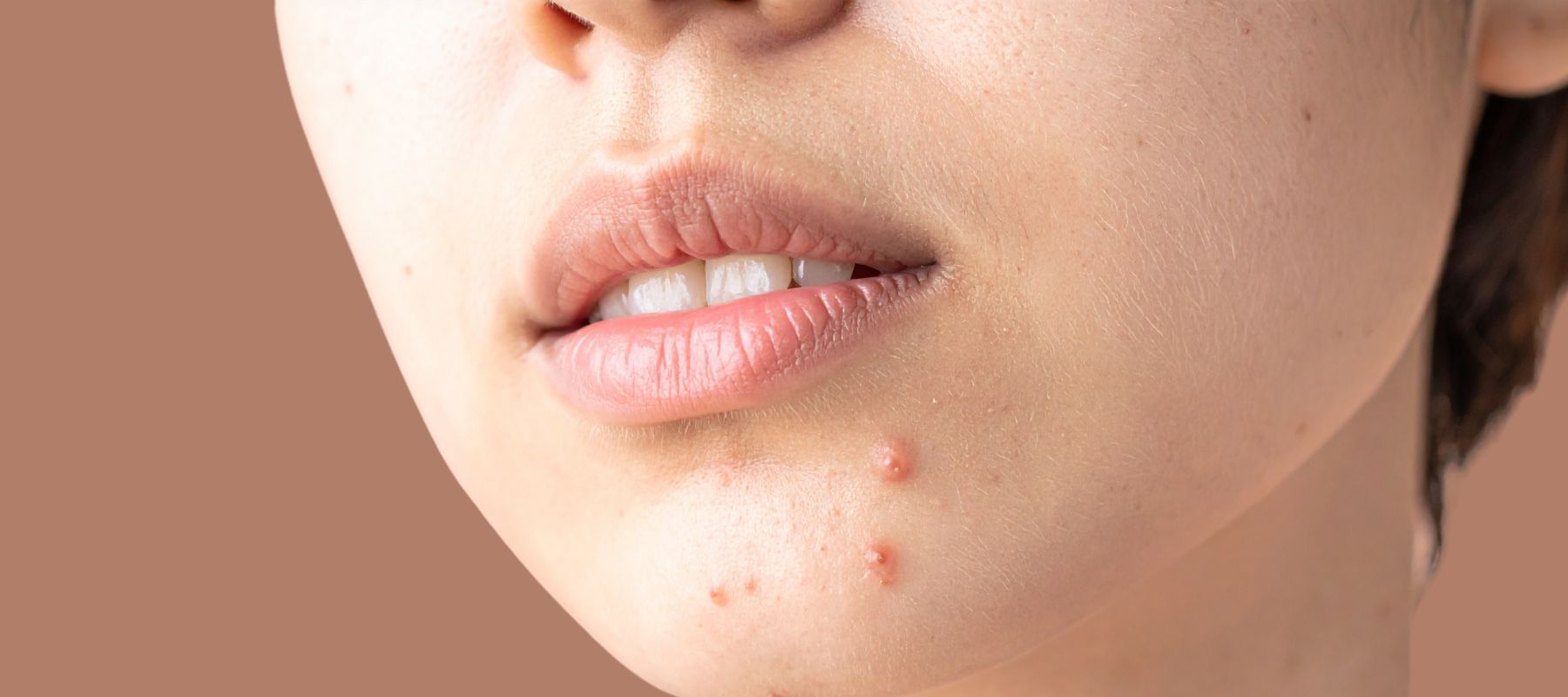 Salicylic Acid for Acne: How It Works, Benefits & Best Skincare Products