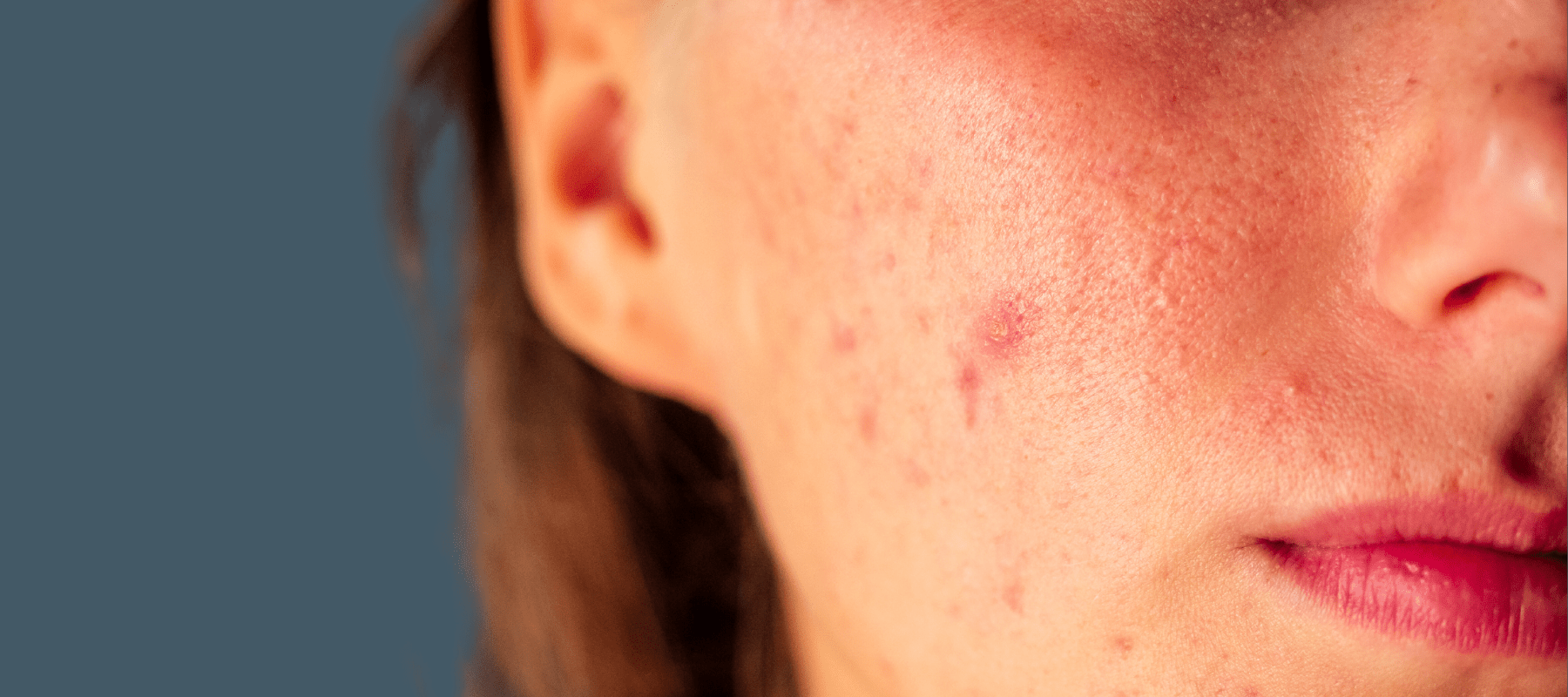 Salicylic acid effectively targets and removes acne blemishes