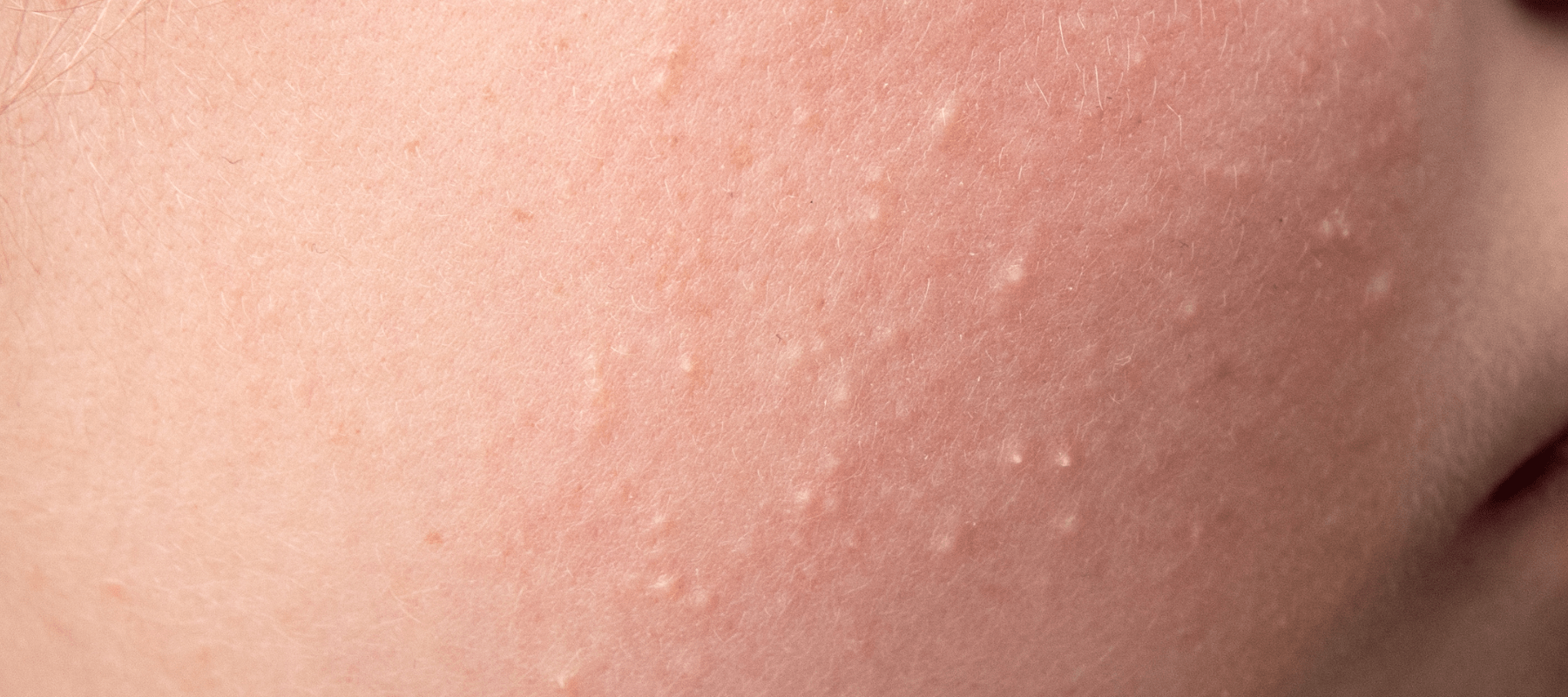 Small bumps on face that are not acne