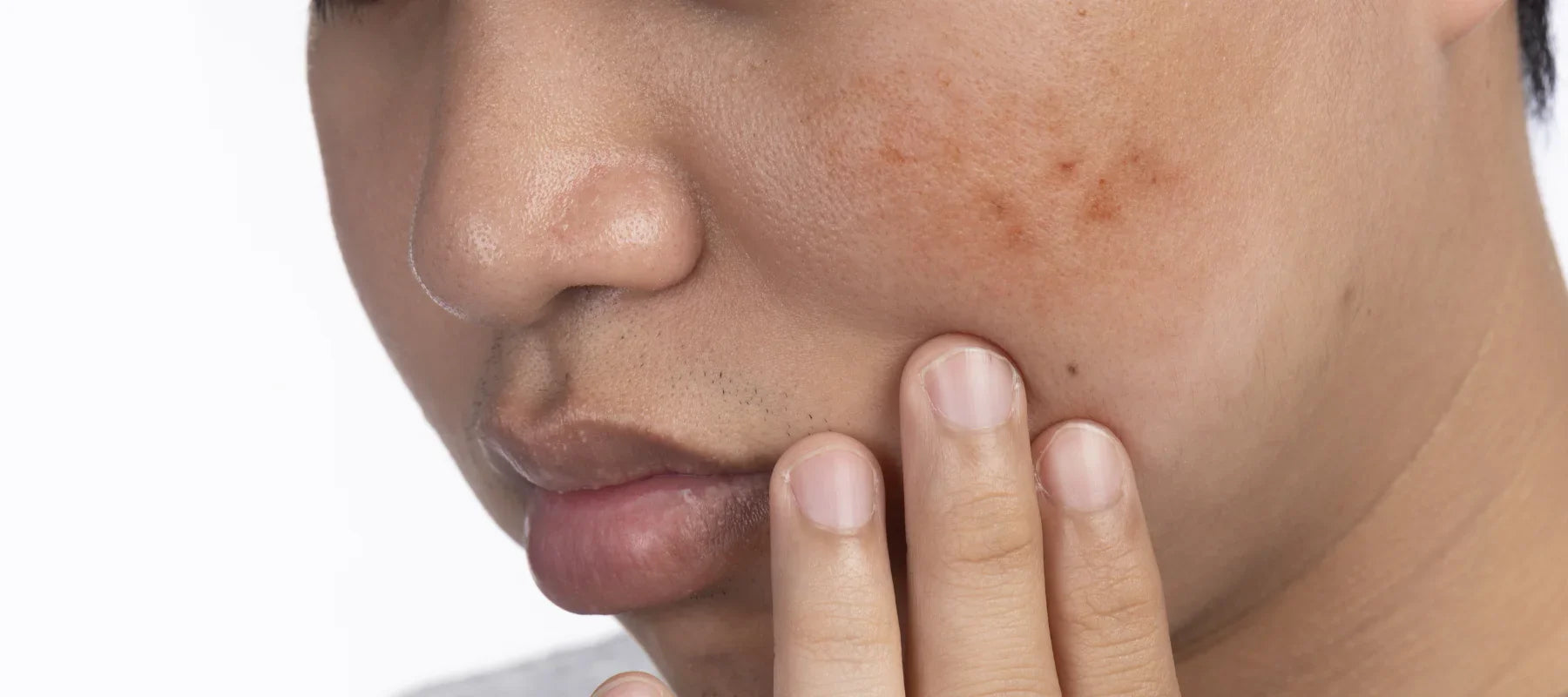 Bumpy textured skin on the face