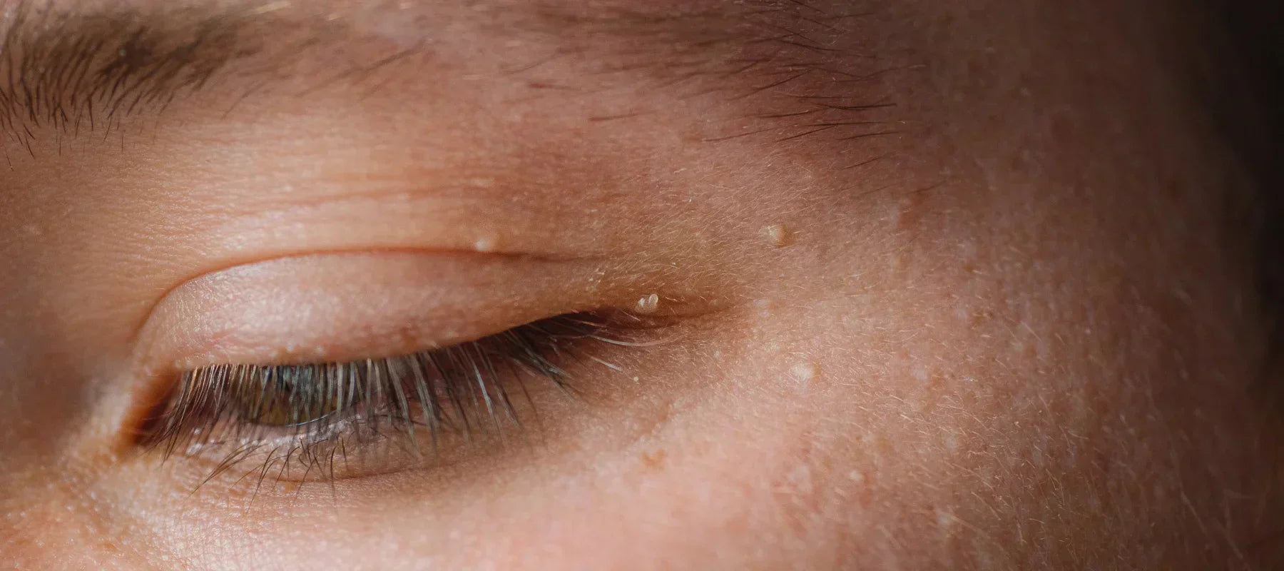 Pimple on eyelid