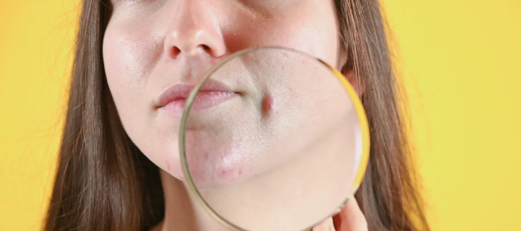 Big red pimples on face