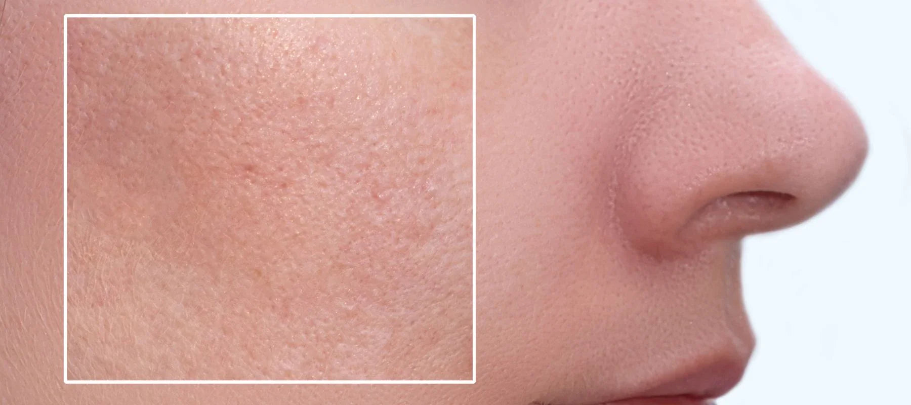 Large pores on face
