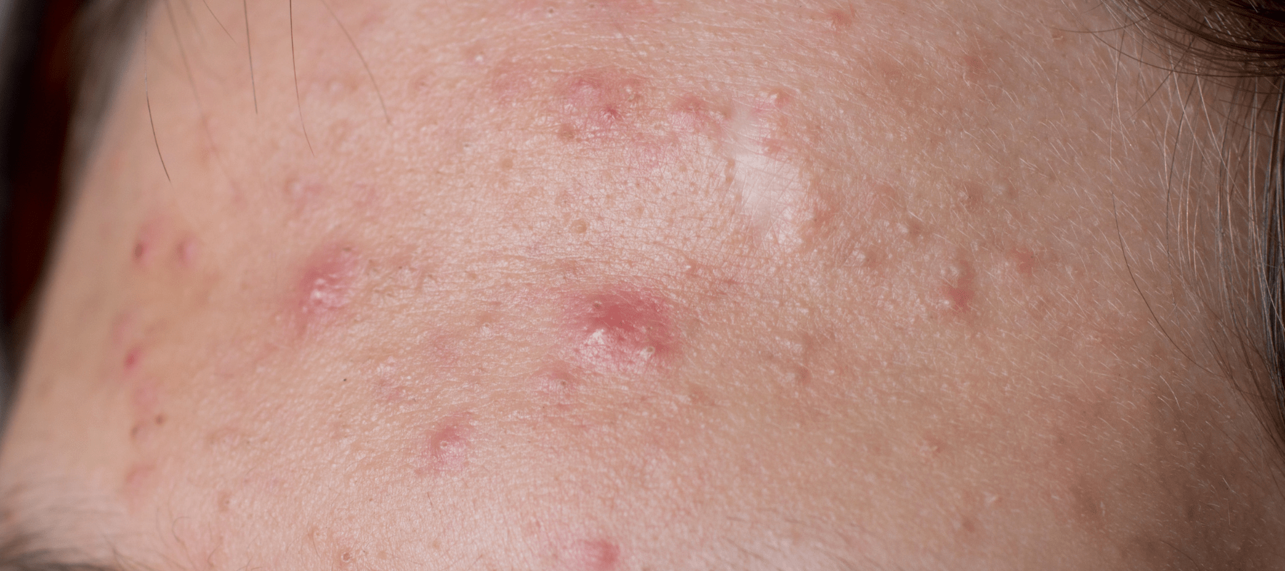 the process of using benzoyl peroxide for acne treatment