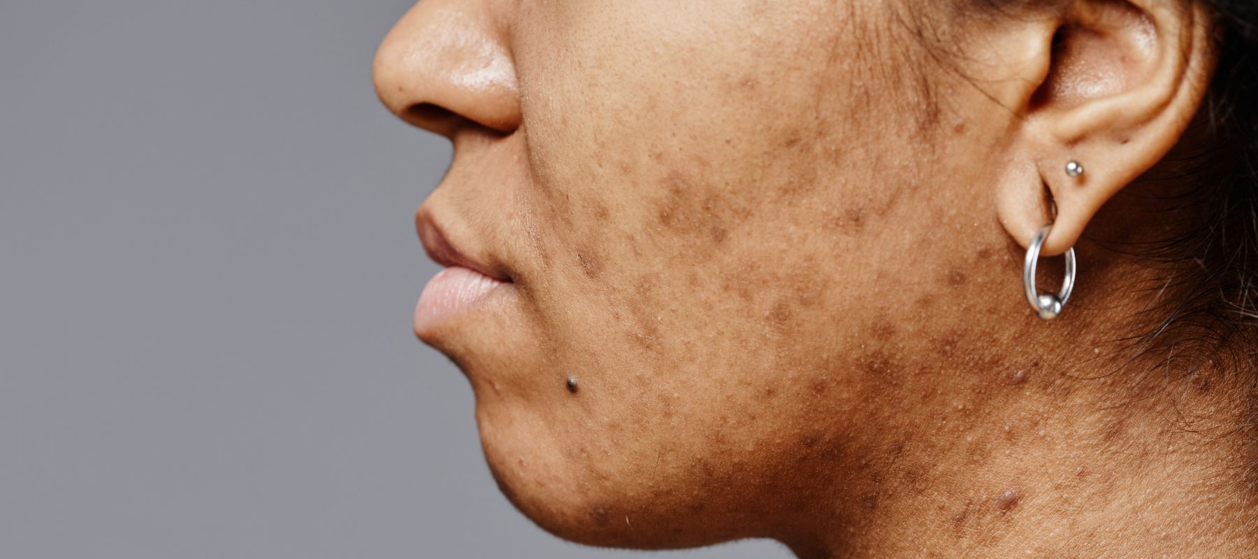 Tranexamic Acid in Skincare: Uses, Benefits for Pigmentation & Top Picks