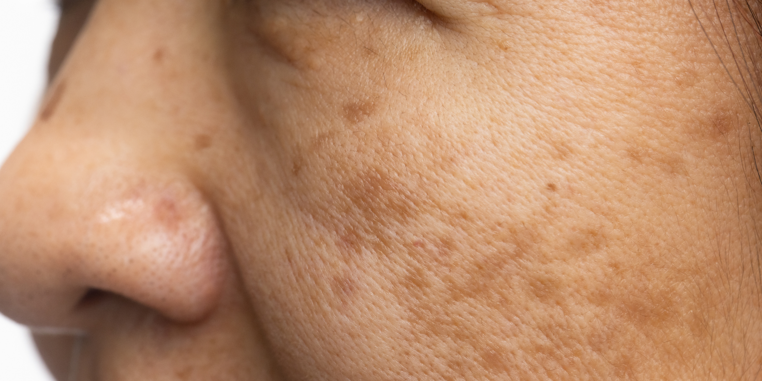 What Are Free Radicals & How Does It Impact Skin Health?