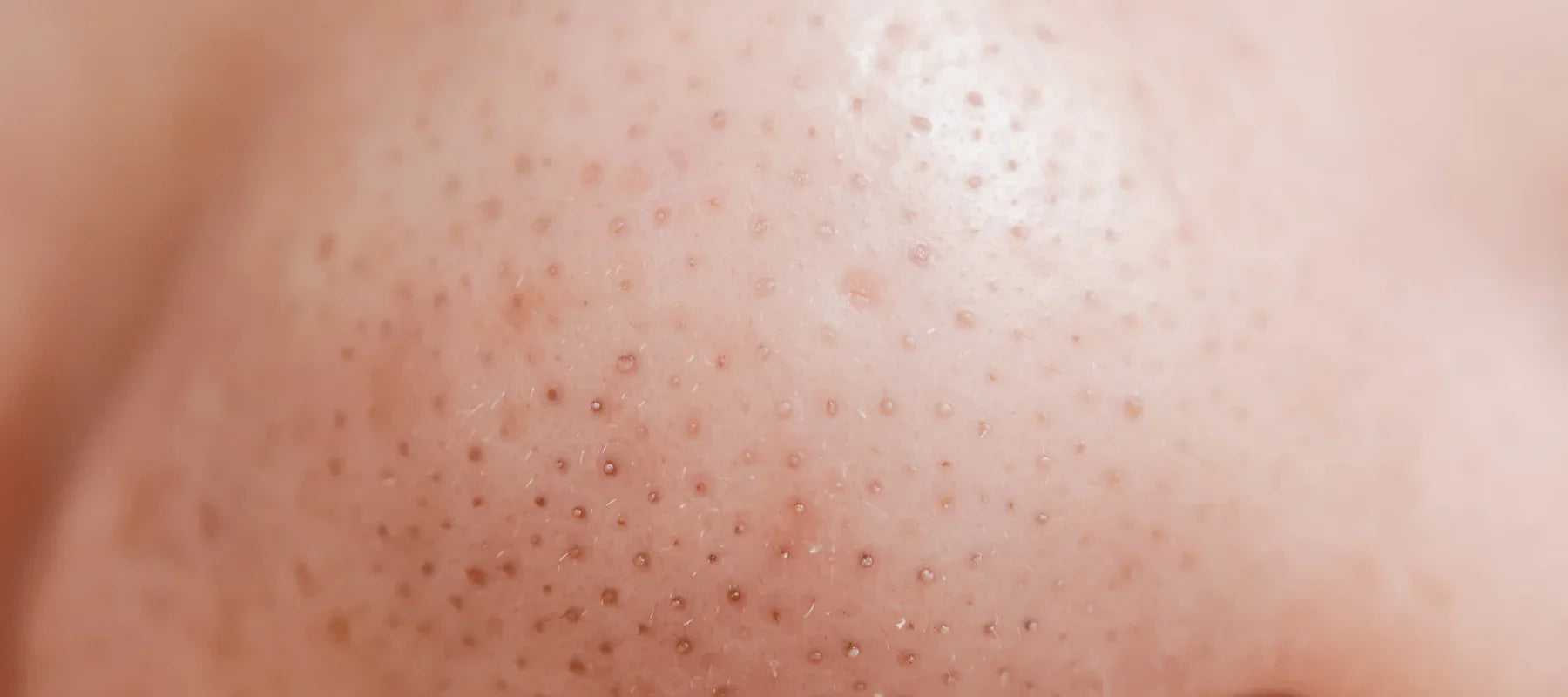 Blackheads vs whiteheads