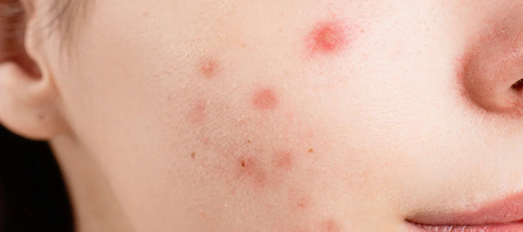 Blood filled pimples