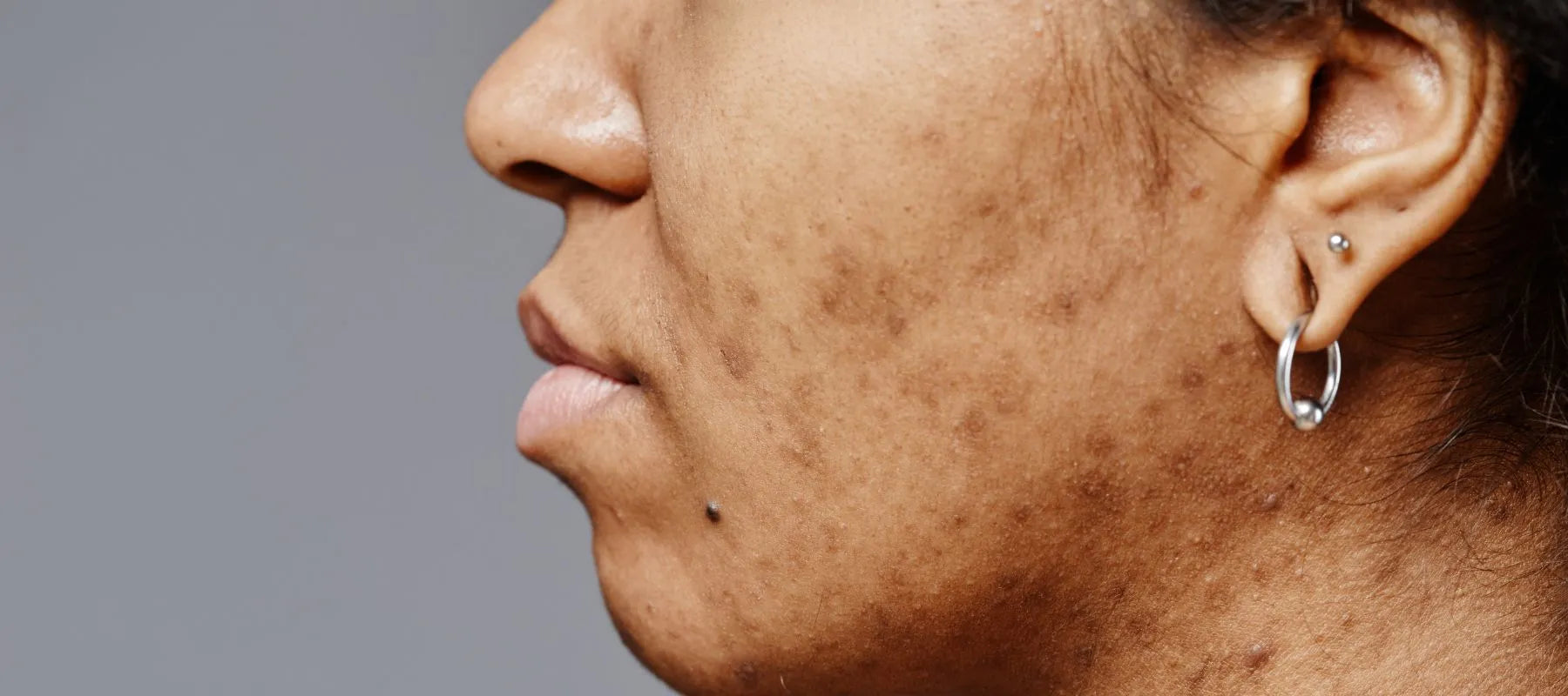 Understanding brown spots on skin