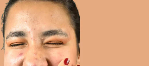 White bumps on face not milia