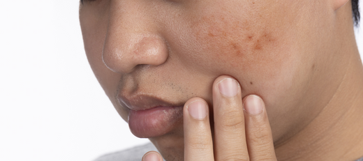 What are dark spot and their causes on face