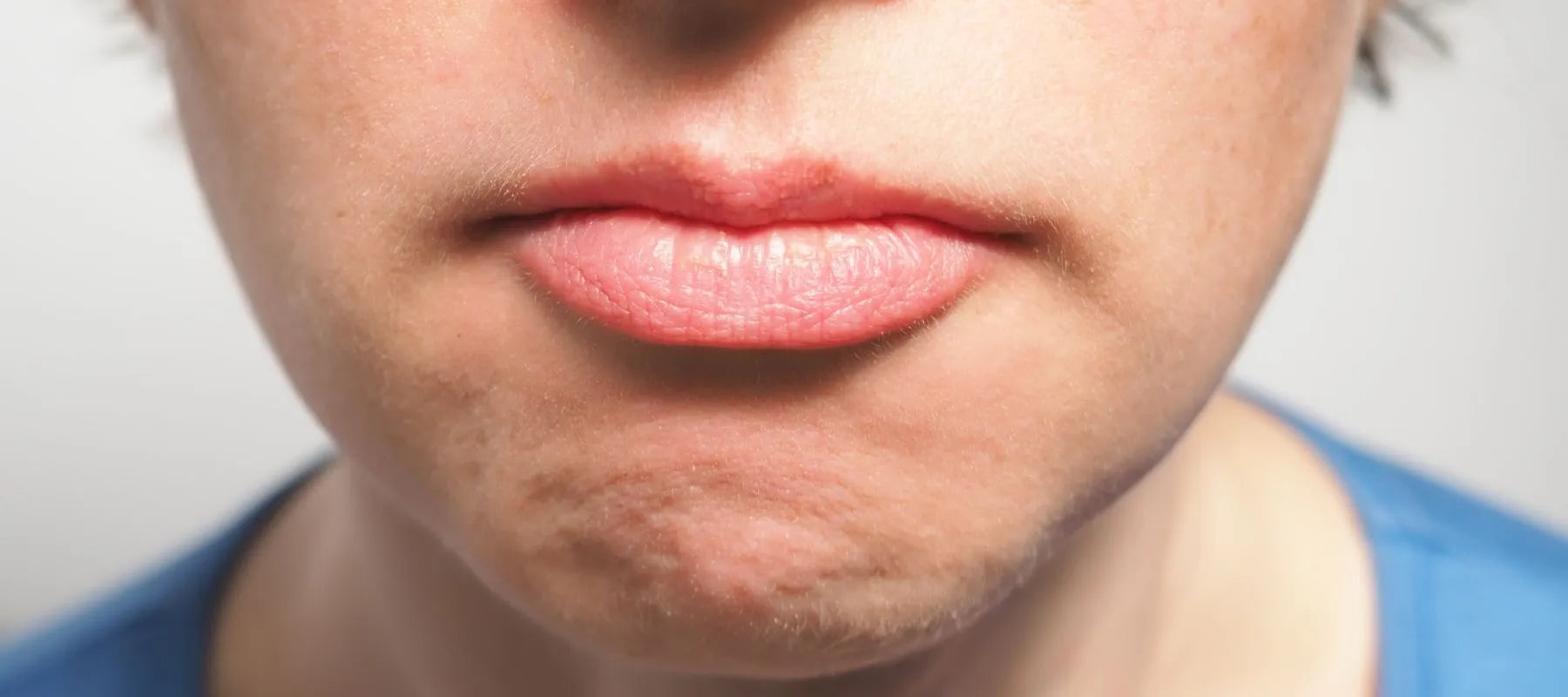 What are frown lines