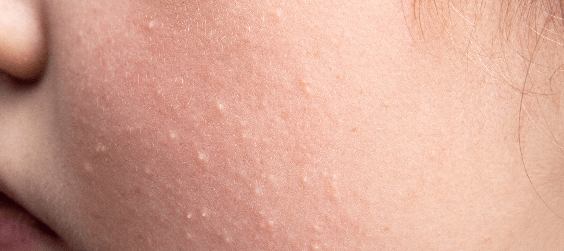 What is comedonal acne and causes of it