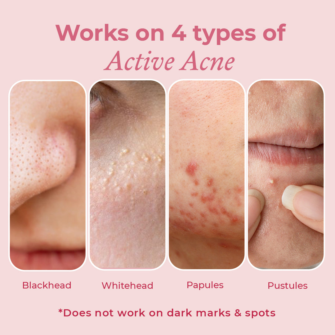 Acne Fighting Duo
