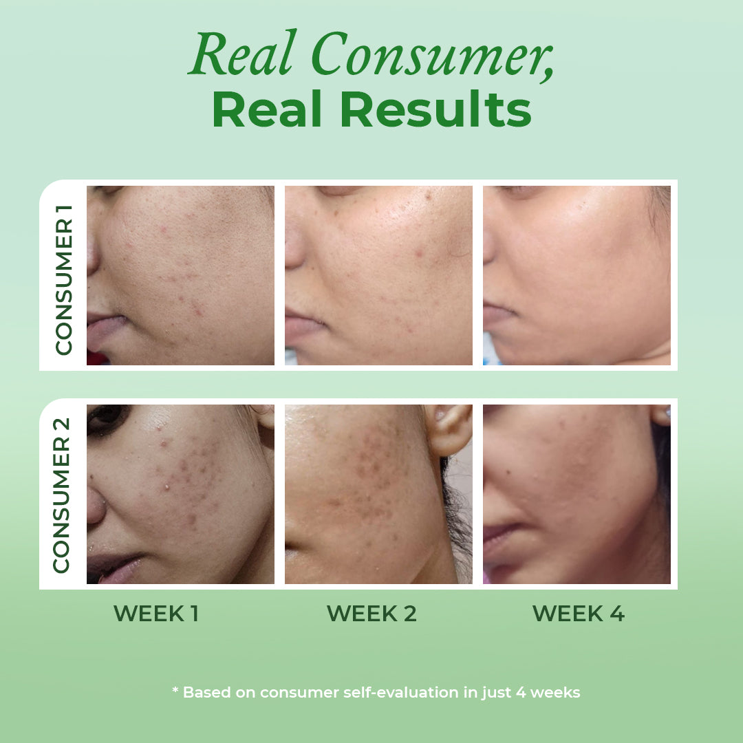 Consumer results of the Acne & Oil Control Intense Salicylic Acid Serum